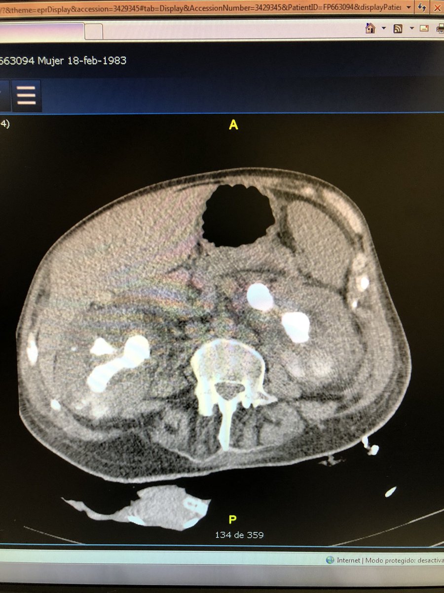 emiliani_e's tweet photo. First PCNL with @oangerri @FPuigvert after being inspired at #wce18 @EndourolSoc. We have to be flexible, sometimes is better to go prone. https://t.co/V82qylBiJ8