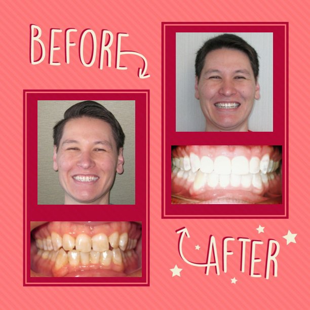 jbbraces's tweet photo. Transformation Tuesday!!!! Call our office today to set up a NO-CHARGE orthodontic consultation to see how we can Transform your smile!! 
#invisalign #nonextraction #newsmile #damonbraces #transformation #jbbraces https://t.co/wy0jvfrmZA