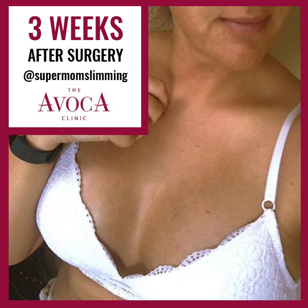 The Avoca Clinic On Twitter Teresa S Breast Augmentation Post Surgery Photos Visit Our Instagram Page For More Https T Co Nm0lhooag0