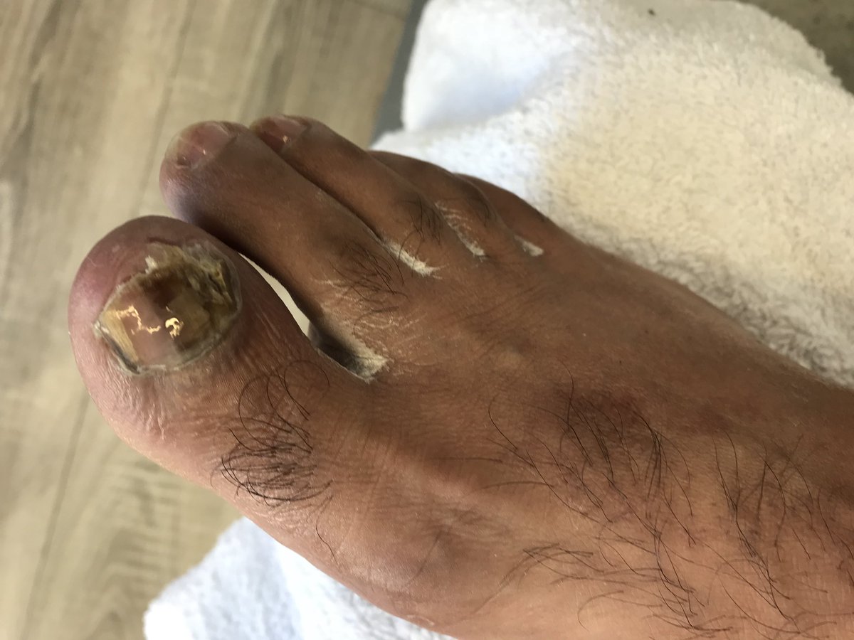 Kikisnailbar123's tweet photo. Don’t suffer in silence. #ingrowingtoenails can cause pain and infection. Treatment is important, don’t wait till@they get infection #kiksnailbar #kiksfootclinic https://t.co/RVcecM8kE2