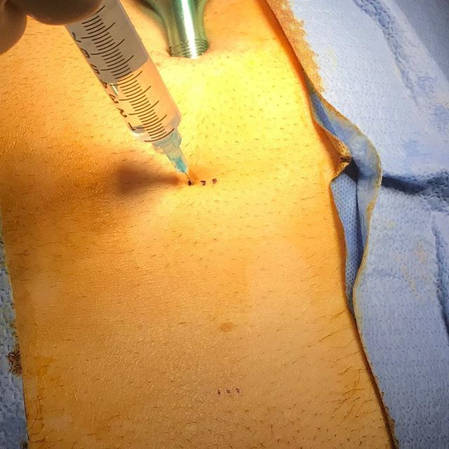 Herniadoc's tweet image. One key to pain-free #recovery after #surgery is use of preemptive analgesia. I liberally use local anesthetic before any incision. This helps reduce pain in the wound after surgery.
.
#TAPblock #localanesthesia #smallscars #painfree #expert #herniasurge… ift.tt/2Q5TGW1