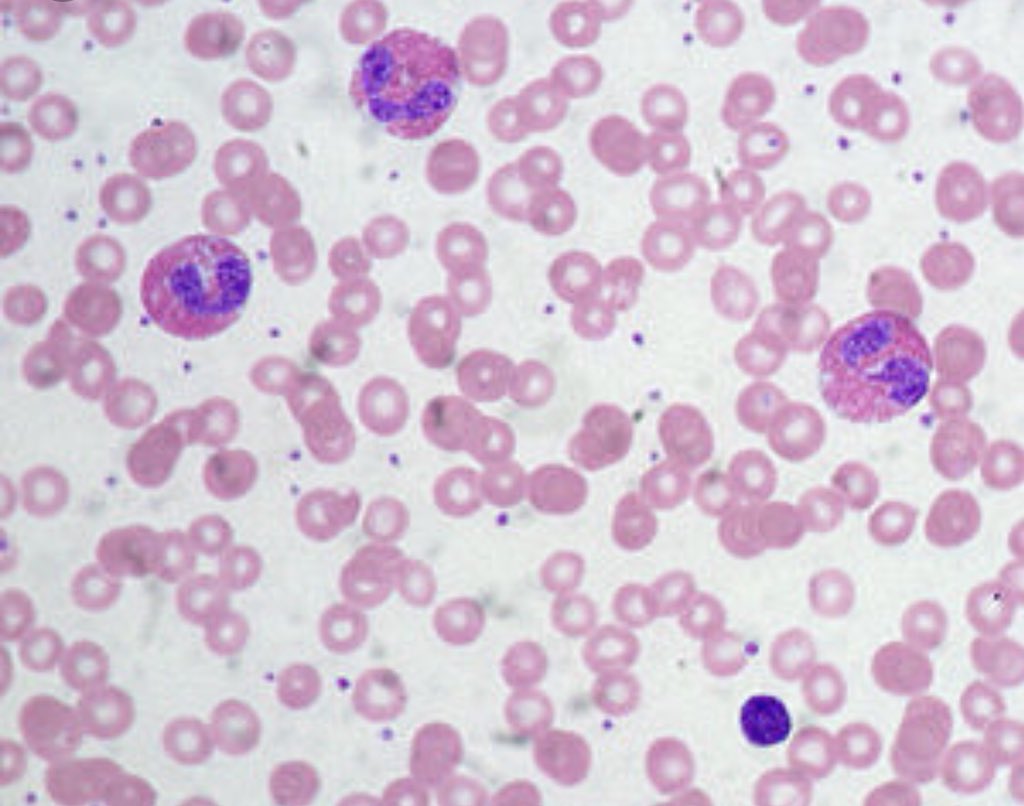 Эозинофилы в мокроте нативный препарат. Клетки мокроты нативный препарат. Эозинофилия в мокроте. Эозинофилия в мокроте. Эозинофмлы про бронхиальной асме.