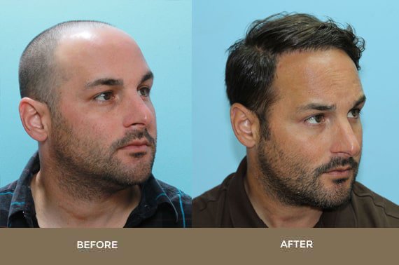 Istanbul Hair Transplant Center Ihtcenter Twitter