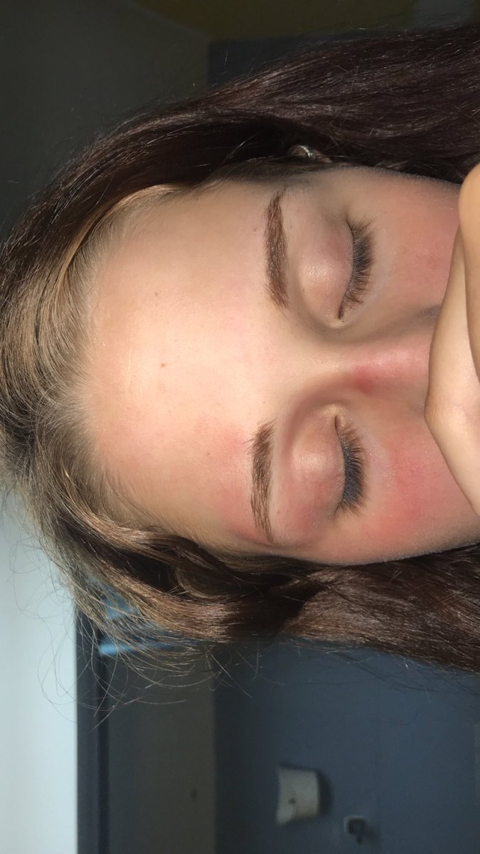 checklesseq's tweet image. today i was at the barn, trying to chase the chickens into their little home. i ran straight ass into a medal rod and this was the result. fuck chickens and fuck me for being an idiot 🤩🤪