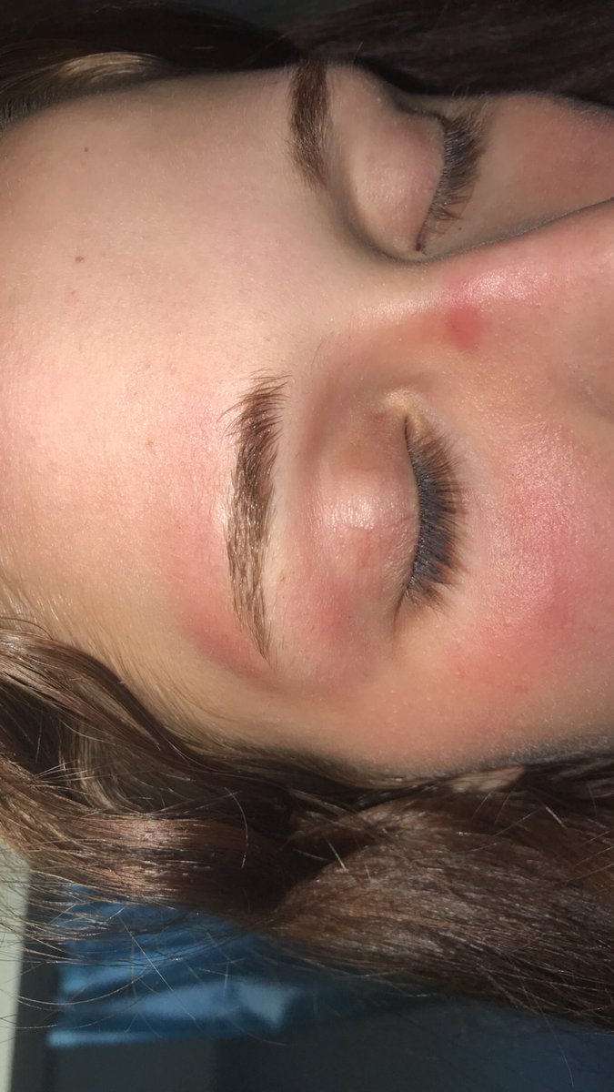 checklesseq's tweet image. today i was at the barn, trying to chase the chickens into their little home. i ran straight ass into a medal rod and this was the result. fuck chickens and fuck me for being an idiot 🤩🤪