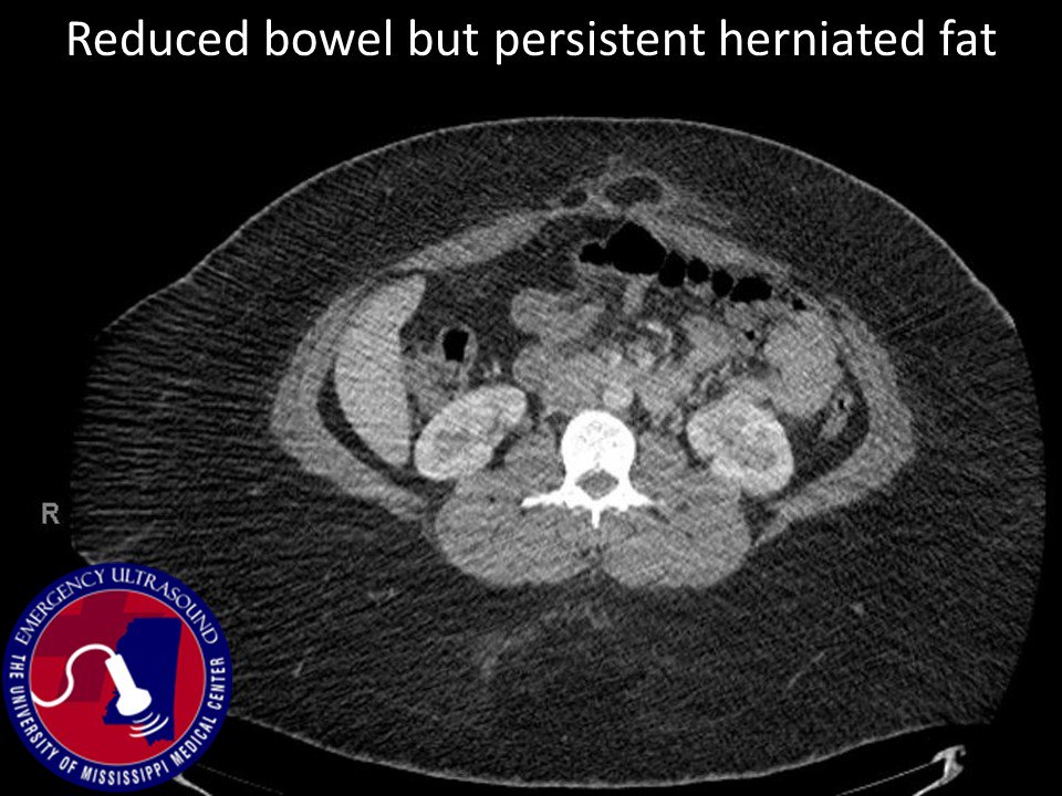 UMMC_EMRes's tweet photo. CT correlation post-reduction of incarcerated ventral hernia  (3/3) #ultrasound #medtwitter #meded #residency #emergencymedicine #EMsono https://t.co/RoBmlgpDym