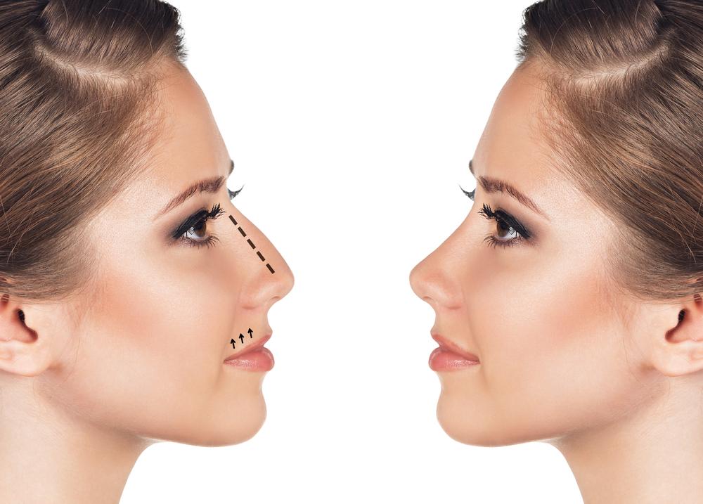 Lindaglass73's tweet photo. Complications from Rhinoplasty... https://t.co/oPD58CXvi9 https://t.co/uMQLLILE6l
