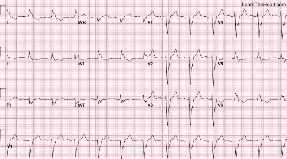 LearntheHeart's tweet photo. Cabrera's sign ➡ Acute MI can be seen on #ECG with LBBB ➡ notch at 40 ms in upslope of S wave in lead V3/V4 #USMLE https://t.co/AQVxTeoQlt