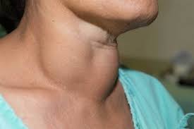 Neuroendocrino1's tweet photo. Searching of Rational Volume #Surgery in Cases of Locally-Invasive Differentiation #Thyroid #Cancer
Know more: https://t.co/lhmkW0XOQU https://t.co/l8ey7iRQuC