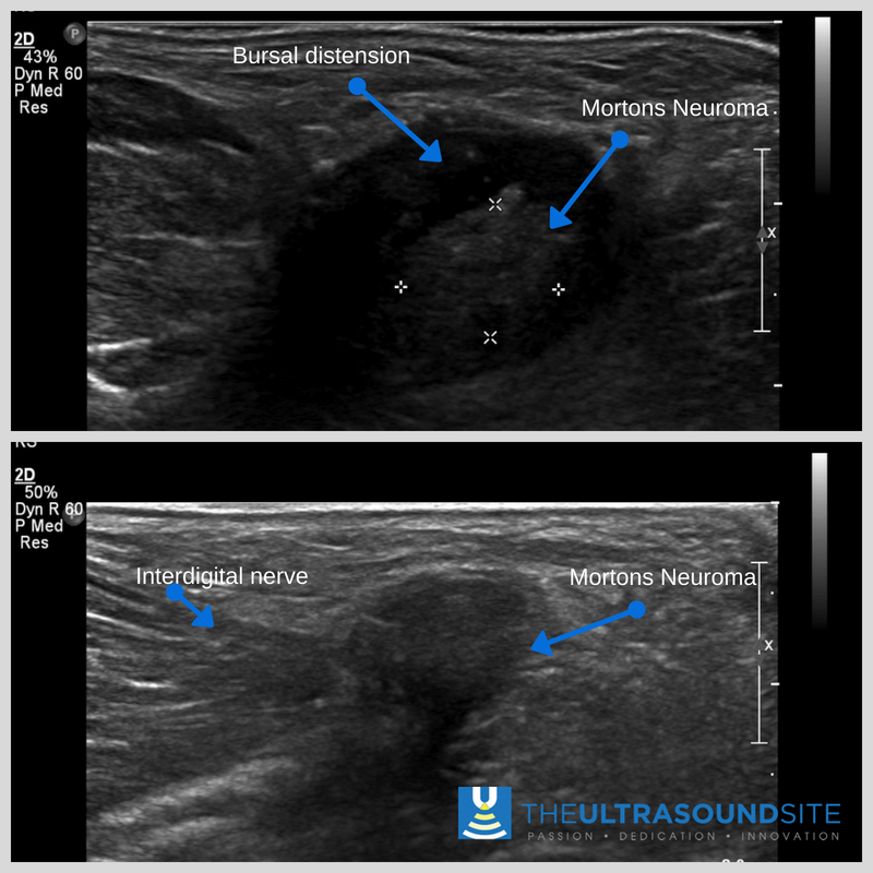 mskultrasound's tweet photo. `MSK Ultrasound - differentiate forefoot symptoms #Mortons/Bursa (as shown) #MTPJ #Plantarplate #stressresponse #tenosynovitis and add info to the clinical reasoning process. Use as another clinical test when assessing. Further reading https://t.co/ZIJ8DI7sUS #TUSSIntro https://t.co/pXUsT1XSGg