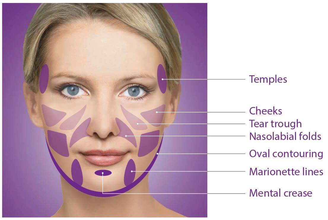 DrAshishDutta's tweet photo. #Sculptra which is an #Injectable #DermalFiller which can smooth-out #FacialLines and #Wrinkles, helping to restore the volume that is lost during the natural #AgingProcess. It #Augments the face by stimulating the body's #NaturalProduction of #Collagen
https://t.co/QPVc1ZBMr8 https://t.co/3xKJ7fOBLC
