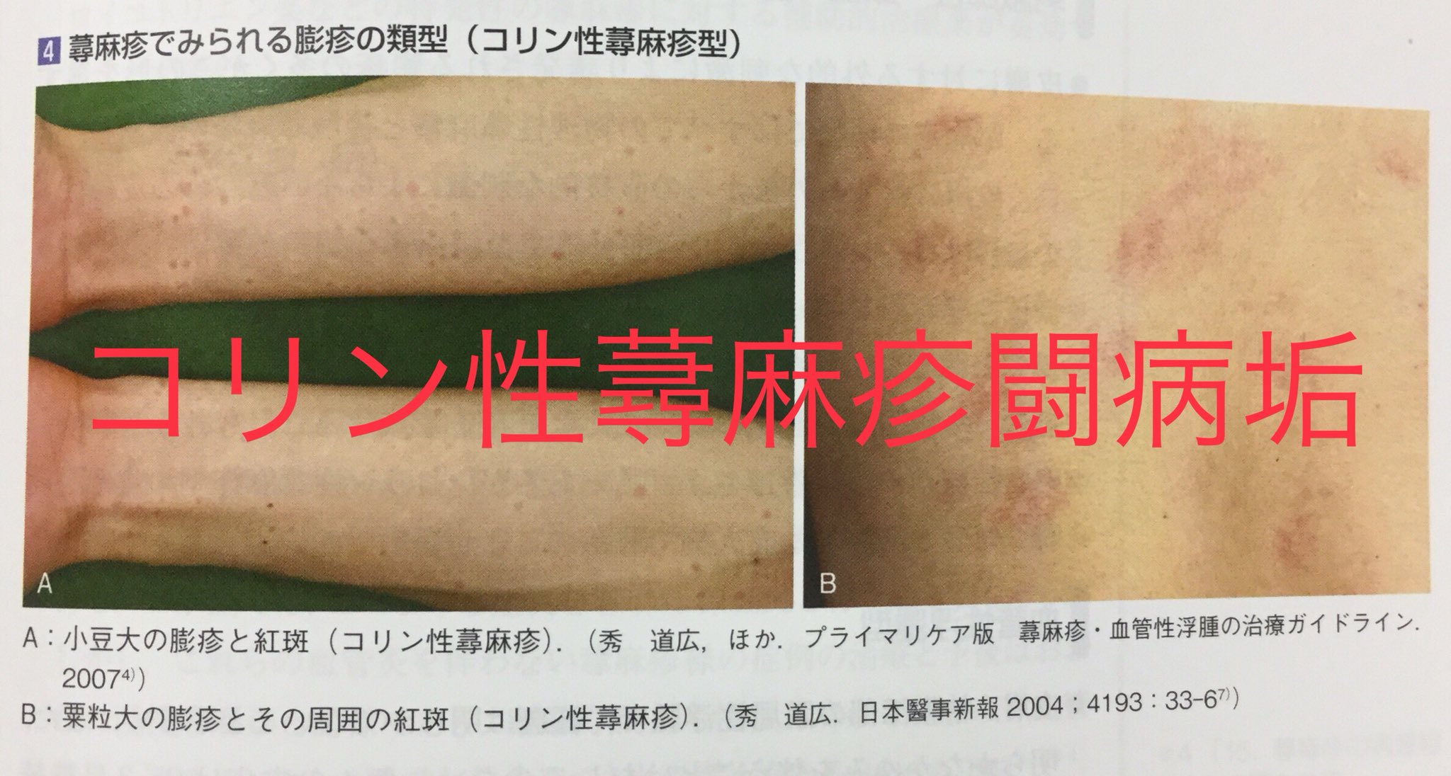 コリン性蕁麻疹闘病垢 寛解中 コリン性蕁麻疹 膨疹 ぼうしん 珍しい症状ではあるが 紅斑だけではなく 白い鳥肌状の皮疹 大きさはいろいろ が出現することもある