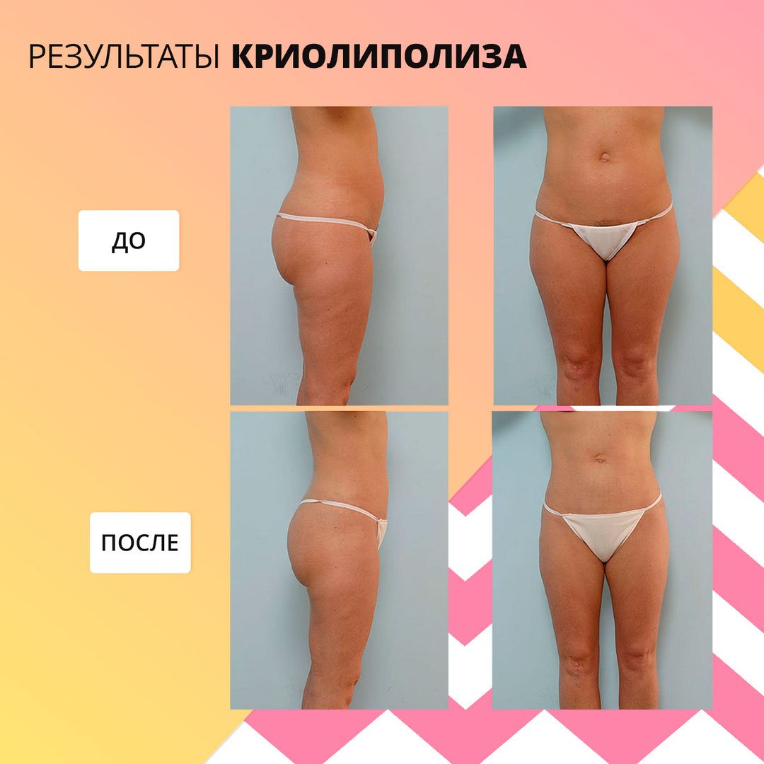 Криолиполиз бедра до и после
