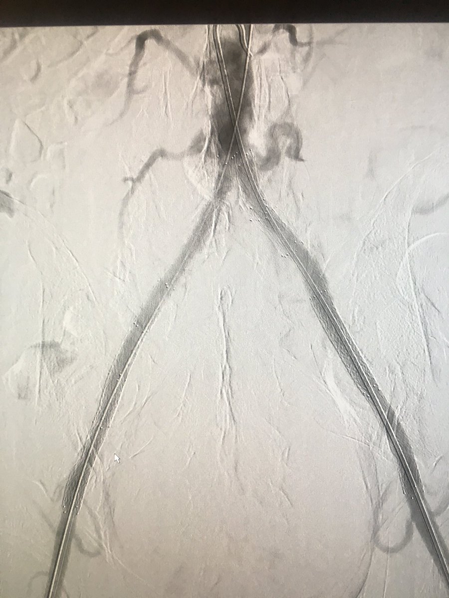 57M right foot nonhealing ulcer after hammertoe surgery, bilateral thigh and calf claudication.  (Don’t mind the internal iliac measurement).  Lake forest @NorthwesternIR @CarlosGuevaraIR @UTHouston_IR @Invasvmd_IR  #wecanrecan #StopTheChop #CLIFighter