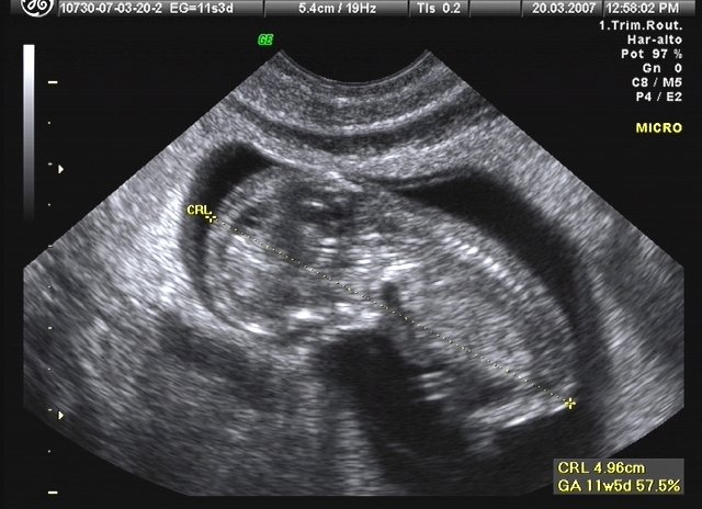 ☤ Anexos: Ultrasonido Fetal. 

Alessia M. E. Snape D'Longbottom 
C.P 20169018