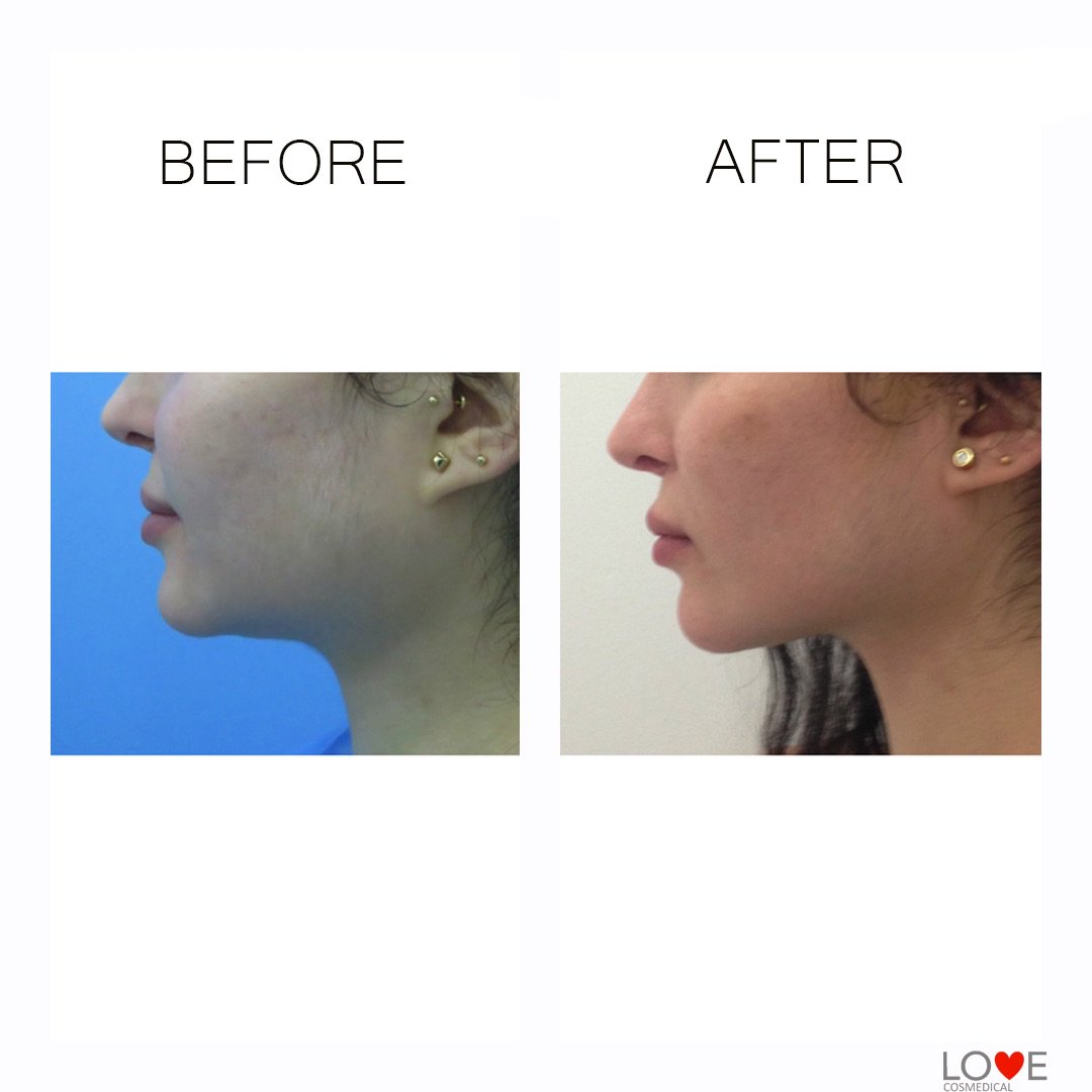 LCosmedical's tweet photo. #Intralipotherapy for the treatment of localized adiposity of double chin. Our product #Desobody offers the optimal concentration of sodium deoxycholate allowing to effectively treat all the types of localized fat deposits. #Desobody #Lovecosmedical #aesthetic #aesthetimedicine https://t.co/Q73Q5vgDpS