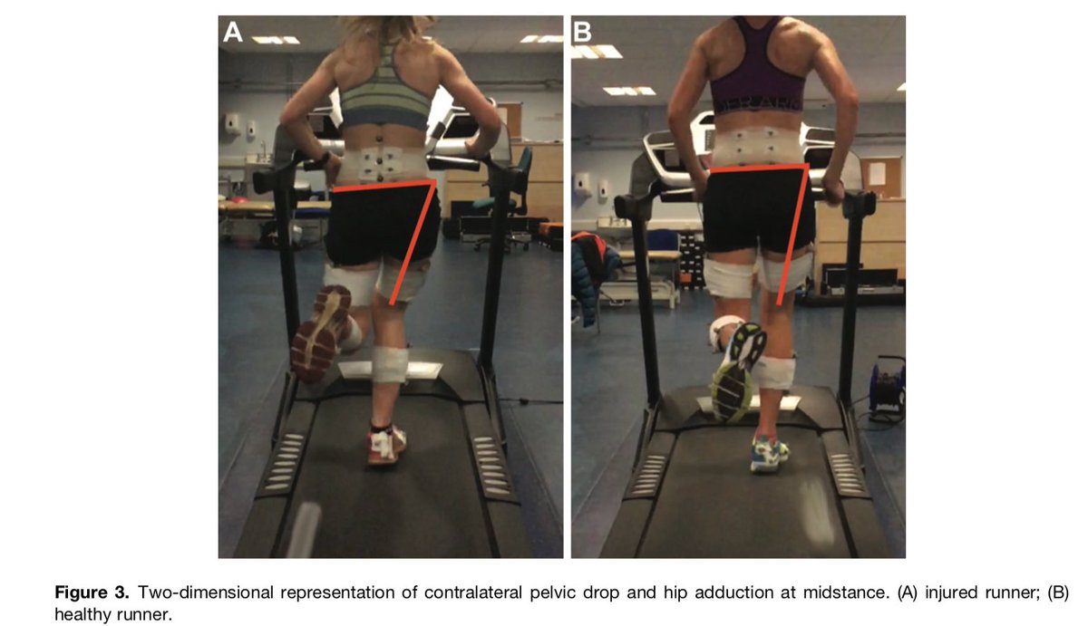 Interesting new study by <a href="/chrisbramah/">Dr Chris Bramah</a> showing contralateral pelvic drop as a "common denominator" for several running injuries &amp; other interesting results 👇
journals.sagepub.com/doi/abs/10.117…
Would love to see this approach applied to sprinting...