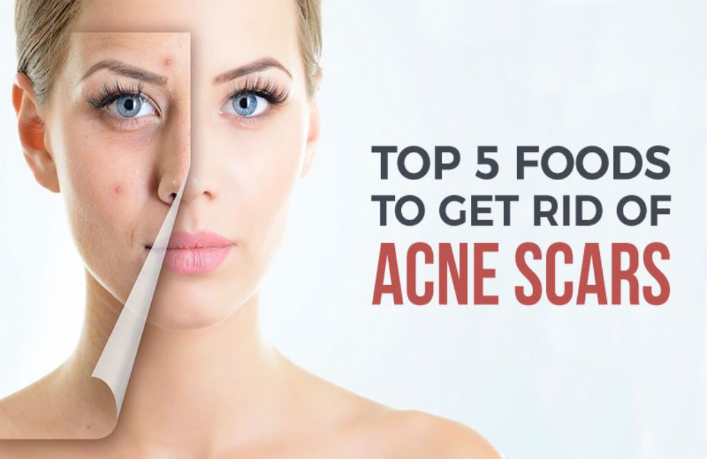 sofiacaligan's tweet image. 5 Home Remedies To Get Rid Of Acne Scars Fast acneskinguide.us/5-home-remedie…