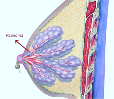 papiloma conducto seno