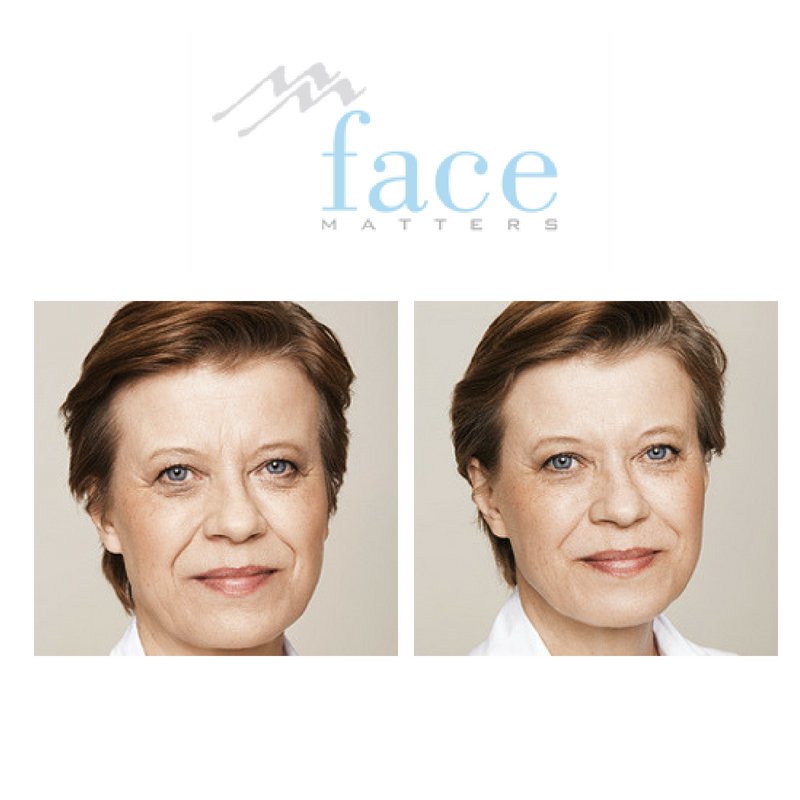 facematters1's tweet photo. Stunning before and after from our Dermal Filler treatment! See more on our website here
https://t.co/DqcAnpgNXt
#FacialAesthetics #AntiAgeingTreatments #AntiWrinkleInjections #Chester #Cheshire #LipEnhancements #LipPlumping https://t.co/FSPaRIqYri