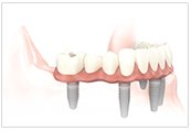 We have a range of dental implant services whether it be just one tooth missing or a few mouthmatters.com/dental-implant/ #DentalImplant #Cheshire #Chester #teeth #NWFollowers