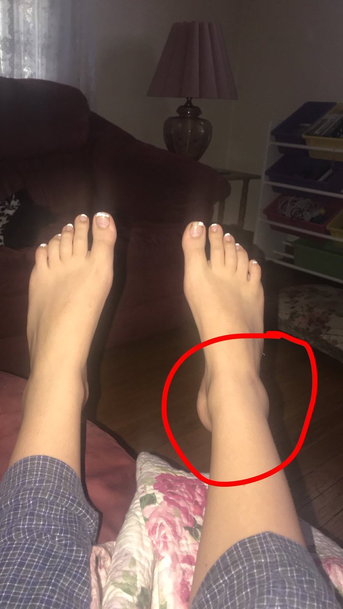checklesseq's tweet image. went to a party got really drunk, fucked up my foot, and i can’t tell if it’s just sore or more serious than that 😅 i can walk on it but it hurts, it’s not too swollen or bruised so maybe it’s fine? idek but hopefully it’s a okay in a few days