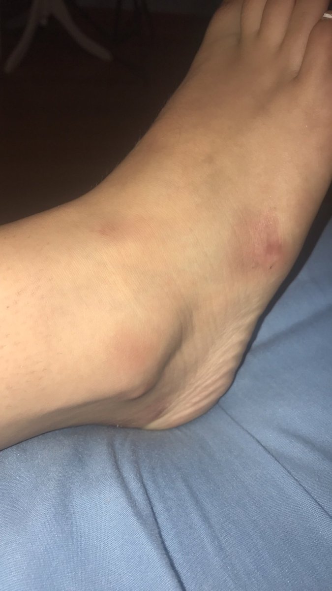 checklesseq's tweet image. went to a party got really drunk, fucked up my foot, and i can’t tell if it’s just sore or more serious than that 😅 i can walk on it but it hurts, it’s not too swollen or bruised so maybe it’s fine? idek but hopefully it’s a okay in a few days