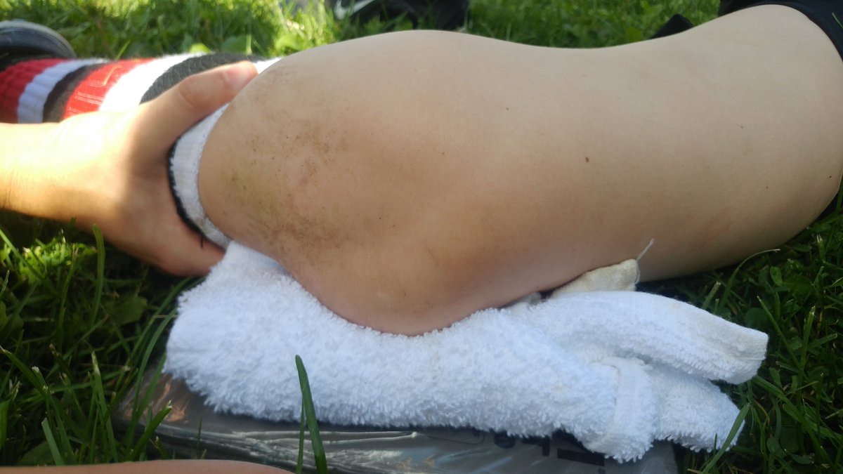 Nice little patellar dislocation to start off my Sunday. <a href="/injurypics/">Injury Pic Page</a> #athletictherapy