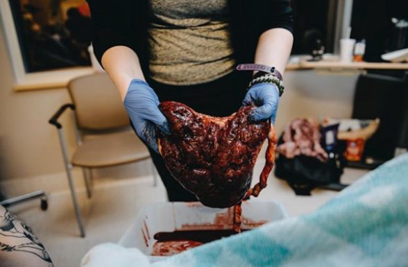 After the birth of your baby, it’s time for the #placenta! This organ only exists during a pregnancy and needs to come out after your baby! Luckily, the placenta is WAY SMALLER then a baby, it’s squishy so it’ll probably be a lot easier! 
•
Credit to 📷: instagram.com/krista.evans.p…