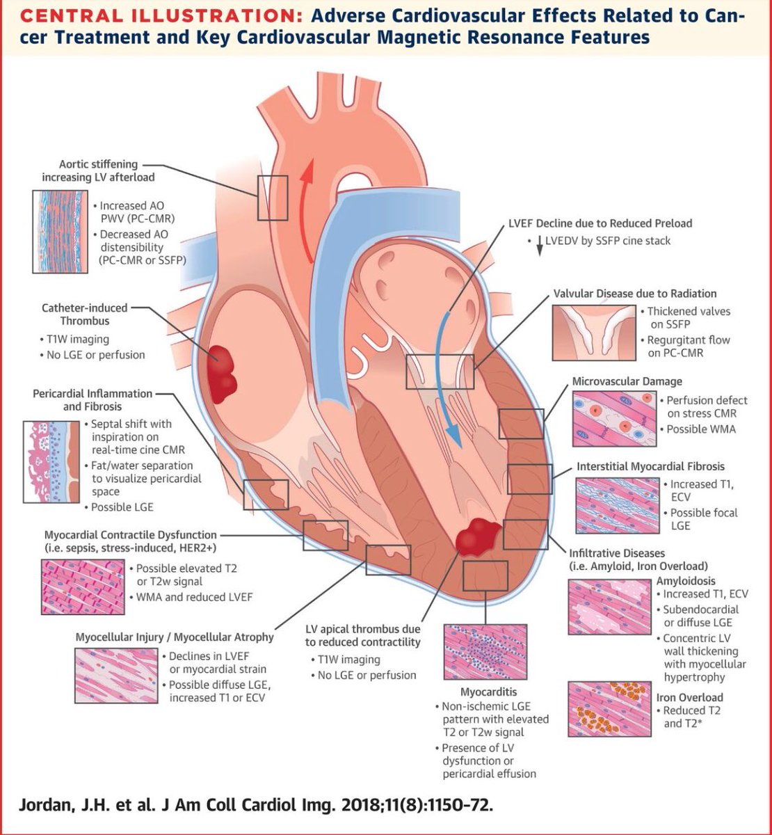 iamritu's tweet photo. 🔑 #WhyCMR  #cancer Rx &amp; #CVD 
cancer Rx ⬇️LVEF
1)⬇️appetite, N/V diarrhea ⬇️ LV pre-load (⬇️ LVEDV)
                or
2)⬆️LVESV(extrinsic ⬆️LV afterload Ao or intrinsic LV: myocarditis, stress CM, contractility, sepsis, &amp; myocellular injury https://t.co/cvwBrF7zEw… https://t.co/QpEZE7kpIv