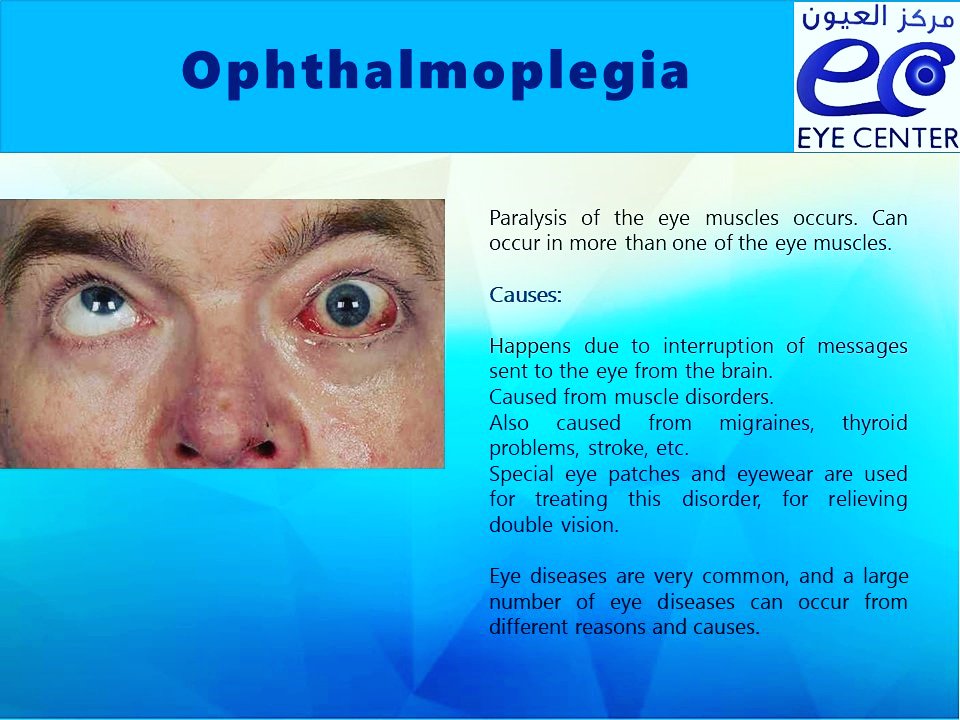 Eye 2024 muscle weakness