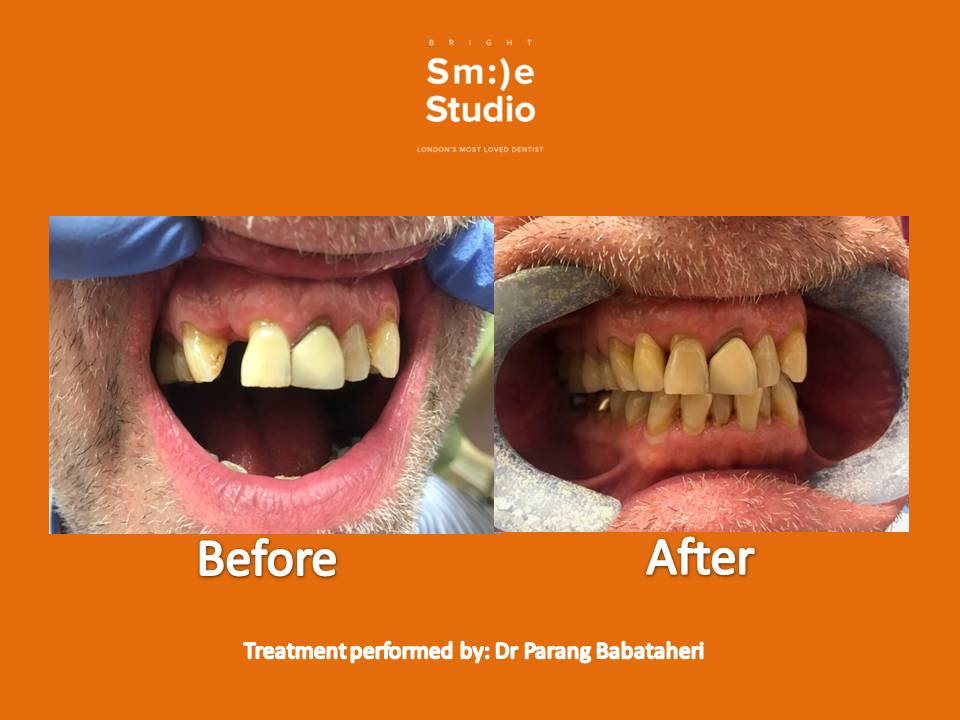 BrightSStudio1's tweet photo. Dental bridge is a false tooth (pontic) held in place by the abutment teeth on either side of the gap. Although pontics can be made from a variety of  materials such as gold, typically they’re made from porcelain to aesthetically blend in with your natural teeth.
#Dentistry https://t.co/NDSeGRDp0g