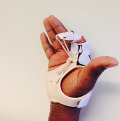 Patient Success! 🌟 Crush injury causing complex finger fracture/dislocation/stiffness. Fabricated this dynamic finger flexion orthosis to increase motion and function. Patient returned to 100% #fullfunction #positivepatientoutcomes #novahandtheraoy