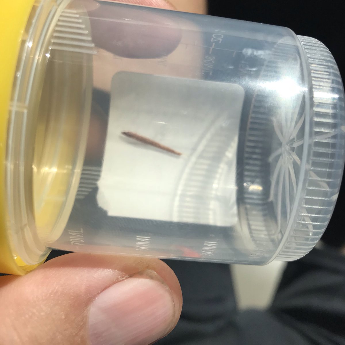 johndoe's tweet photo. I don't recommend splinter in finger, but I do recommend @StatMedCA if you have to get one as big as in 3rd &amp; 4th pics removed https://t.co/nmB32ljC27
