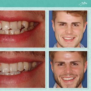 Considering a new smile this year? Read about your teeth straightening options at Mouth Matters mouthmatters.com/index-html/%0A… #Cheshire #Chester #Dentist