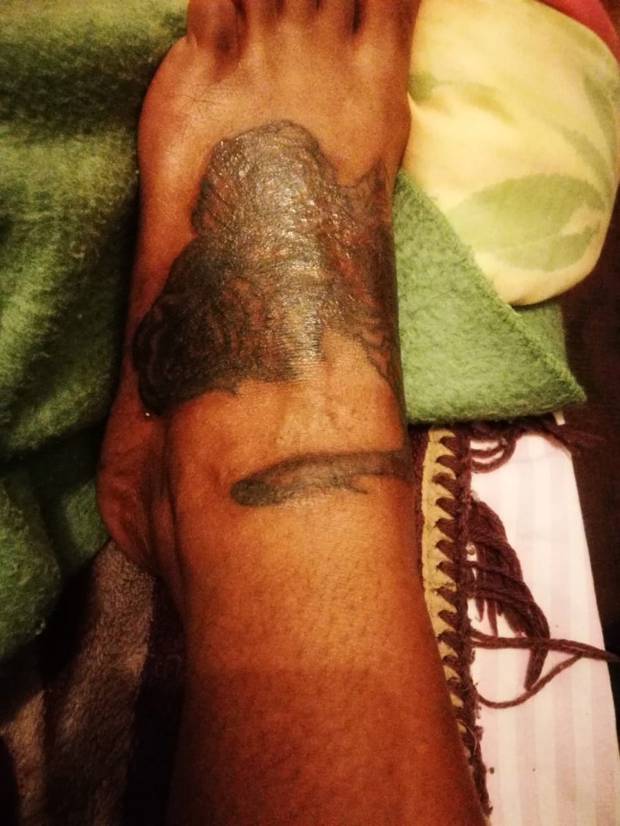 Traumatmc's tweet photo. Burn marks Covered up with flowers https://t.co/tWyOnta6vc