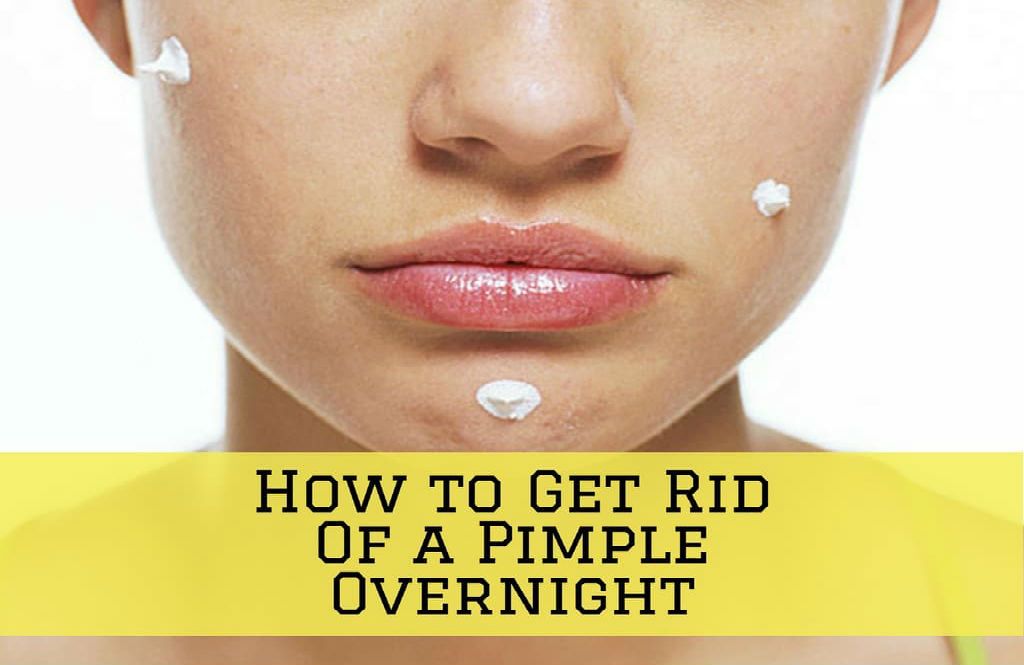 sofiacaligan's tweet image. How to Get Rid of Pimples Overnight – 8 Tips to Get Rid of Acne Fast acneskinguide.us/how-to-get-rid…