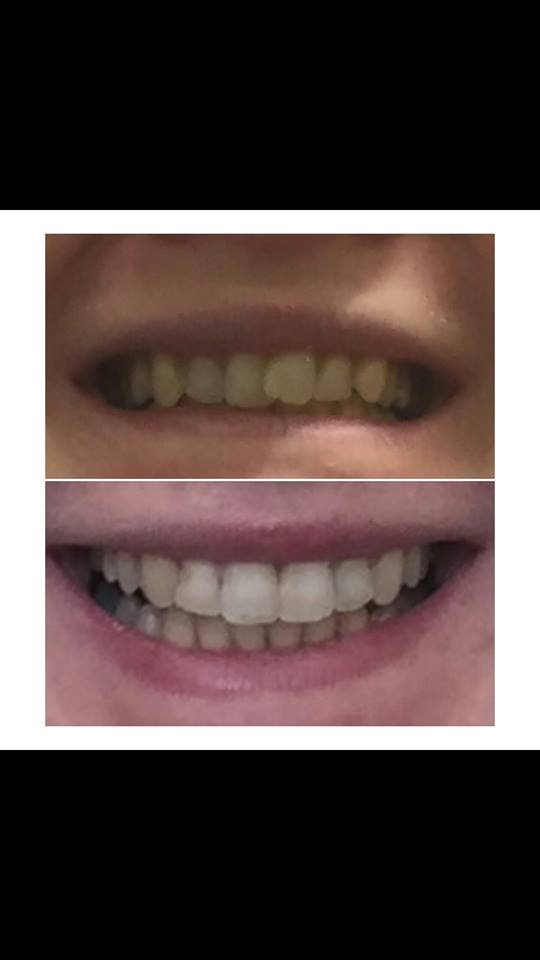 Check out our before and after gallery to see some great results - book a consultation and we could be improving your smile during 2018. mouthmatters.com/cosmetic-denti… #Dentist #Chester #Cheshire #Teeth #Smile