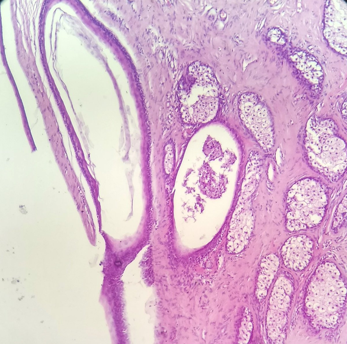 DrNishatAfroz2's tweet photo. Dermoid cyst lateral side of eyelid !#Pathology #histopathology #surgpath #humanpathology https://t.co/vPRlLQQU7s