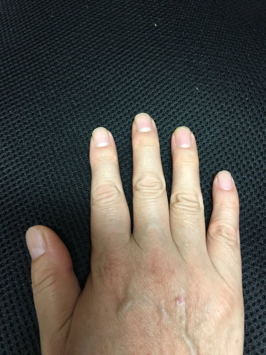 Twitter पर あきこ ミネラルを補給して初期のへバーデン結節が快癒してると言っても中々わかってもらえないのです 痛みは薬指にかすかにあるのみ 以前は薬指 人差し指を触ると強い痛みがありました 小指の変形は治んないらしい 人それぞれですね へ