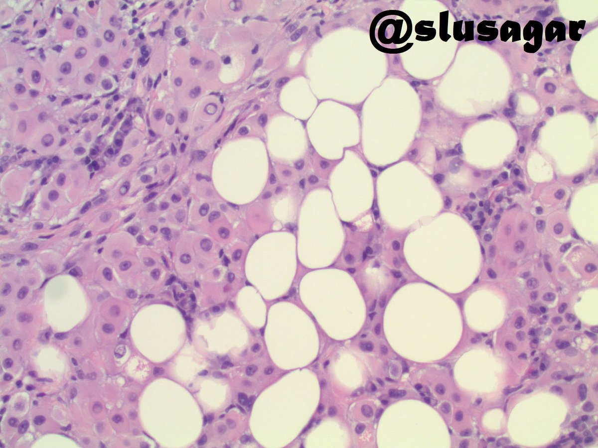 multicystic peritoneal mesothelioma pathology outlines