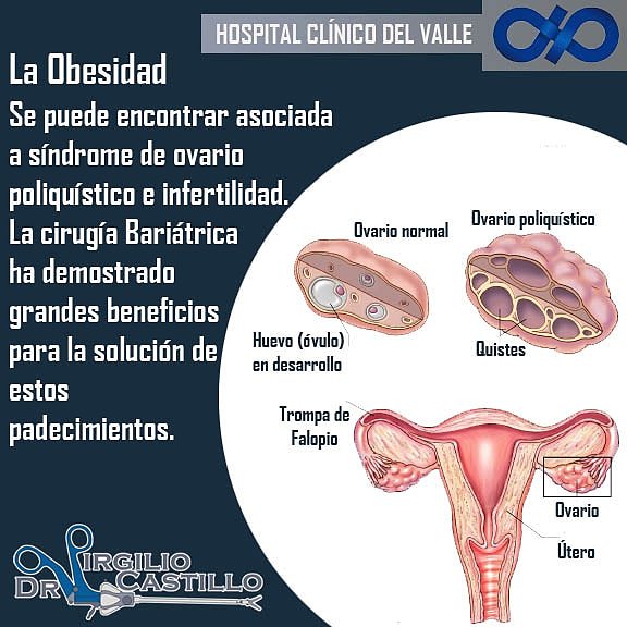 ulapvalle's tweet photo. La #Obesidad se puede encontrar asociada a #síndrome de #ovario #poliquístico e #infertilidad.
La #Cirugía #Bariátrica ha demostrado grandes #beneficios para la solución de estos #padecimientos 
@virgiliocastill
@drvirgilioc
#Medicina #Médico #Cirugía #Laparoscopia #Salud #Mérida https://t.co/UpHSq9XRUI