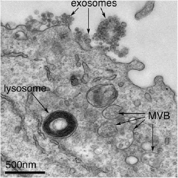 theNCI's tweet photo. Some tumors may evade the immune system by secreting small membrane-encased sacs called #exosomes: https://t.co/FJnBi4YCzn #immunotherapy https://t.co/LvOLXByb26