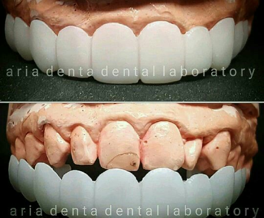 amanidental's tweet photo. removable veneer...jadi vener yang bisa di lepas pasang.. gigi tanpa diasah cocok untuk yang mau gigi tampak terlihat lebih putih dan rapih ..untuk informasi bisa langsung hubungi kita yaaa di wa :  081808924866 line : drganna https://t.co/tjQwhMaCWd