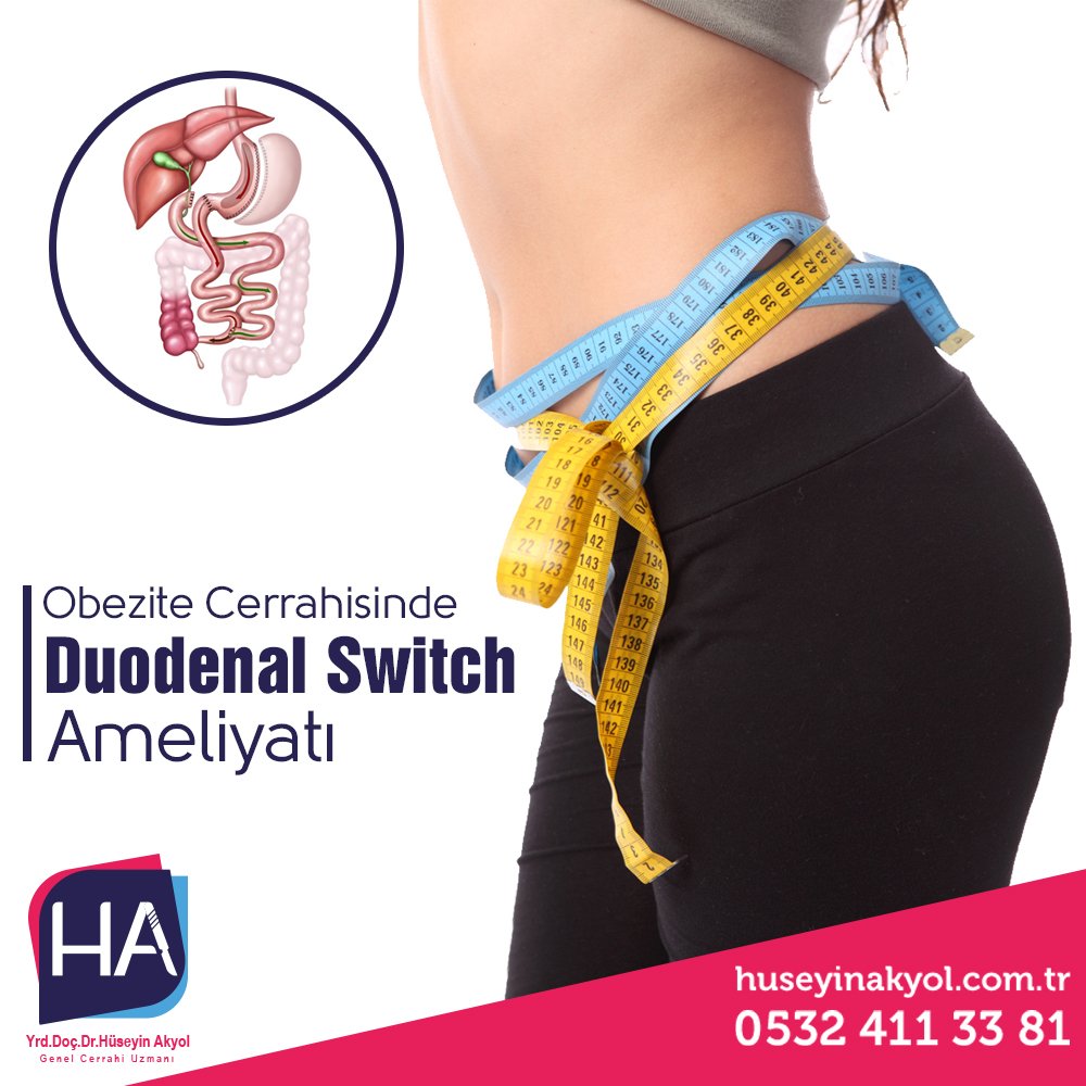 Obezite cerrahisi yöntemlerinden birisi olan Duodenal Switch Bypass, hem kısıtlayıcı, hem de emilimi azaltıcı etkileri olan ameliyatlardandır. 

#drhüseyinakyol #medicalpark #drhuseyinakyol #obezite #obesity #morbidobezite #obezitecerrahisi #obesitysurgery #DuodenalSwitch