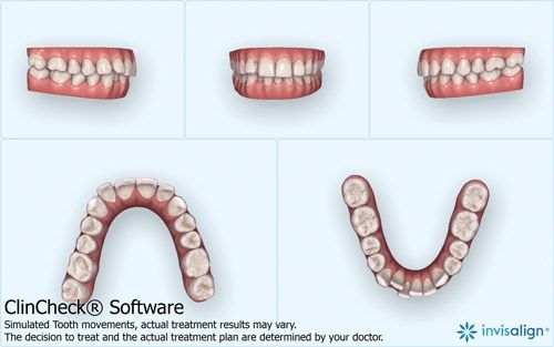 While you may be aware of what Invisalign® is, the Invisalign® treatment now addresses many cases, from simple to more complex.
orthodonticproductsonline.com/2018/09/maxill…
#Clear #Invisalign #ClearAligner #Treatment #Dentist #Orthodontist #SimpleCases #ComplexCases