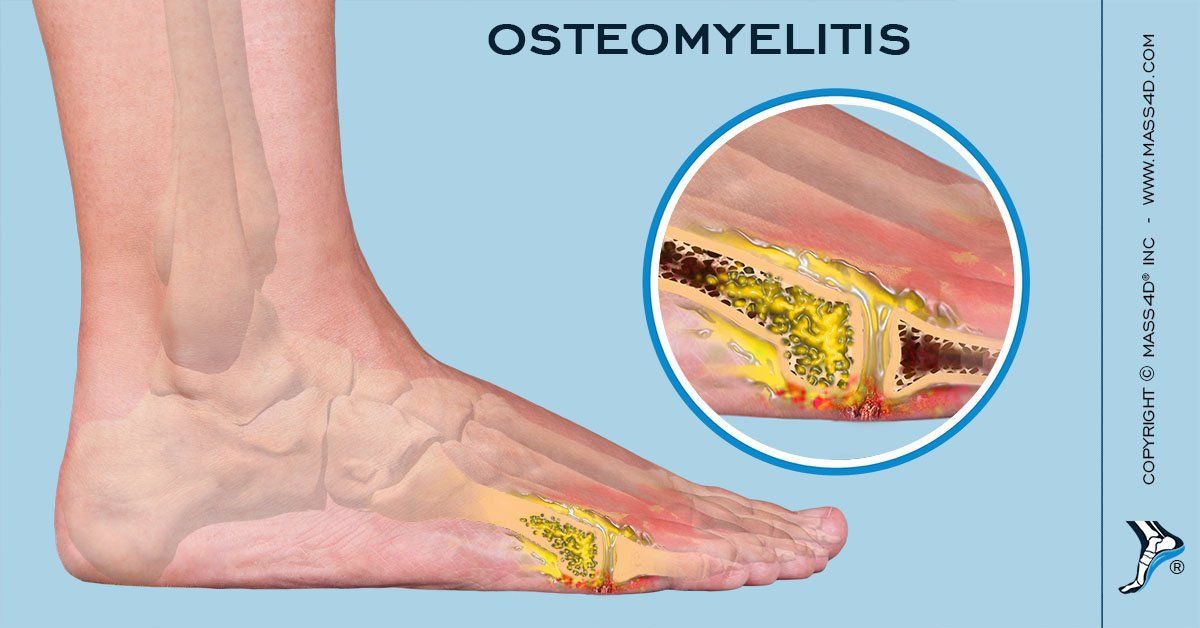 David G Armstrong On Twitter Is Long Term Antibiotic Therapy Just As Effective As Amputation For Chronic Osteomyelitis Https T Co O3clvc62uc