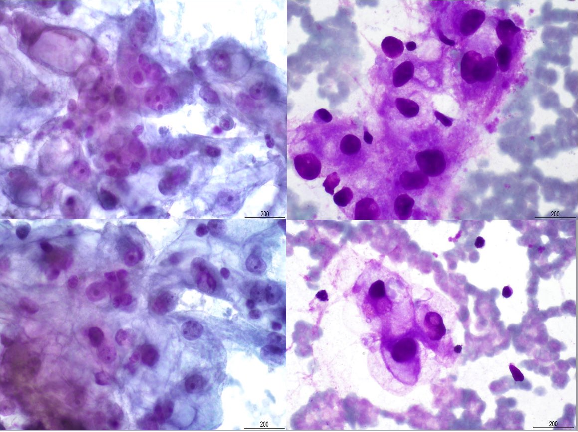 SamKhader's tweet photo. #FNA of a pre-auricular mass demonstrating #tumor cells that are reactive to Pax-8, CK-PAN (AE1/3) and Carbonic anhydrase 9 (CA9) in a circumferential membranous pattern, but negative for CK7, CK20 and RCC. Dx. #Renal Cell #Carcinoma, #Clear_ Cell type. Credit: Siba El Hussein. https://t.co/s2u5Q6hoKR
