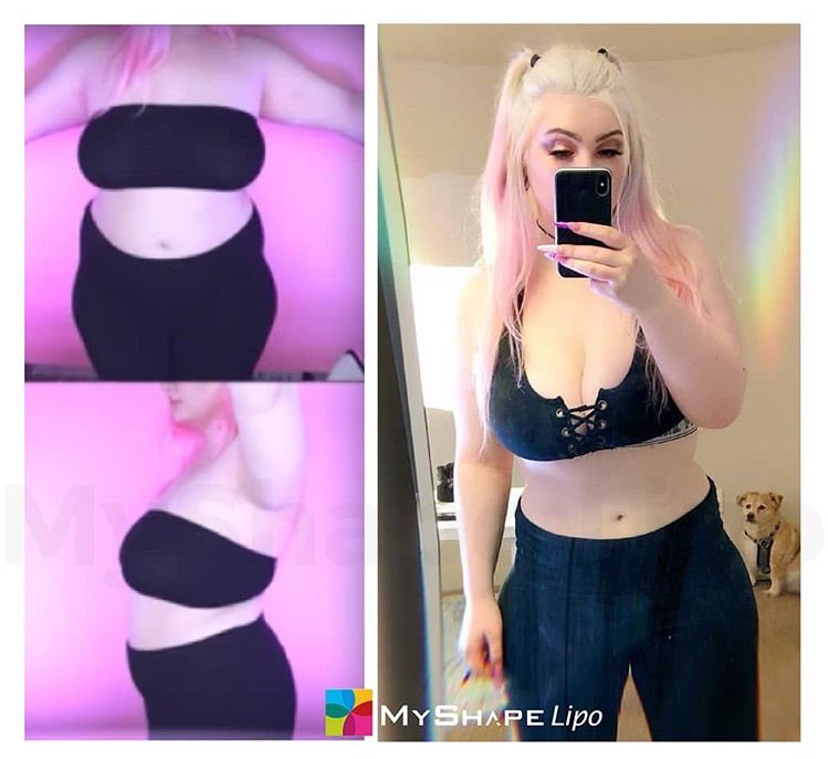 myshapelipo's tweet photo. Wowowowowow look at @emilysusanahh’s incredible results 😻😻😻😻😻😻🙌🏻🙌🏻🙌🏻🙌🏻🙌🏻 #micdrop #beforeandafter #bodygoals #goals #dreambody #liposuction #lipo https://t.co/8arMSOwX3q