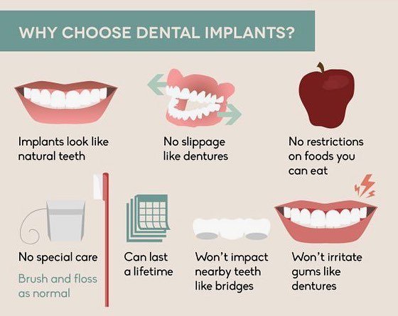 cfcdsfl's tweet photo. Why choose Dental Implants?
.
.
#CFCD #MiamiFL #DentistMiami #ArunGargDMD #DentistHallandaleBeach #DentistPembrokePines 
#DentistAventura #DentistMiami #MiamiTopDentist #DentalImplants #DentalExpertMiami #SmileMakeover #MiamiSmileMakeover #Miami #Florida… https://t.co/ygmZqXtOZ4 https://t.co/8908TiFaYY